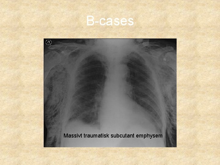 B-cases Massivt traumatisk subcutant emphysem 
