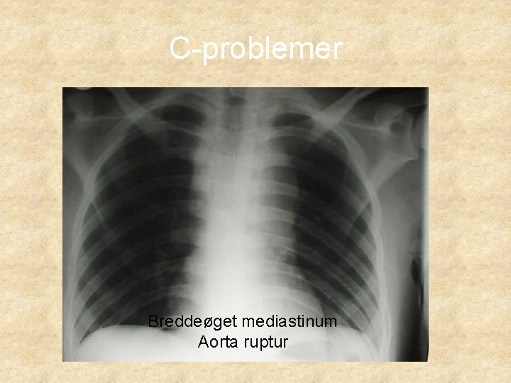 C-problemer Breddeøget mediastinum Aorta ruptur 