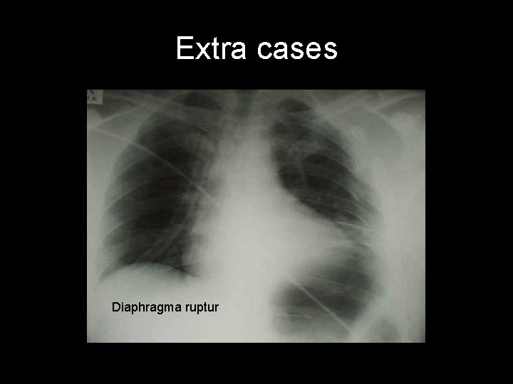 Extra cases Diaphragma ruptur 