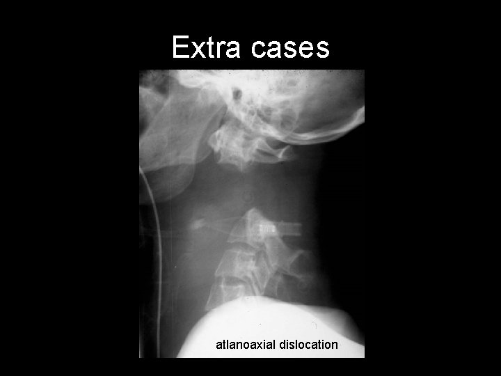 Extra cases atlanoaxial dislocation 