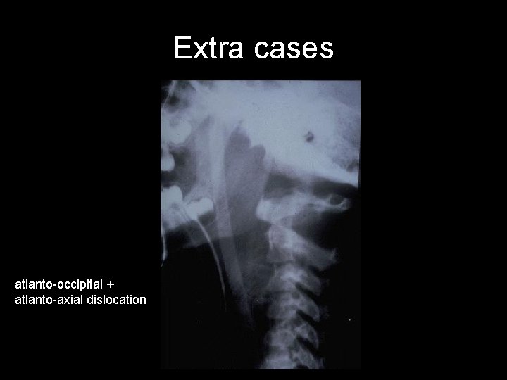 Extra cases atlanto-occipital + atlanto-axial dislocation 