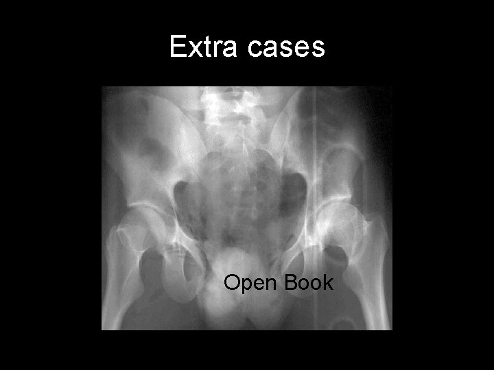 Extra cases Open Book 