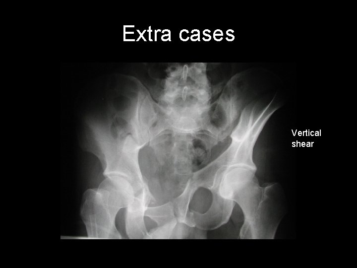Extra cases Vertical shear 
