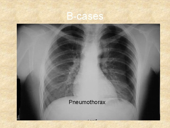 B-cases Pneumothorax 