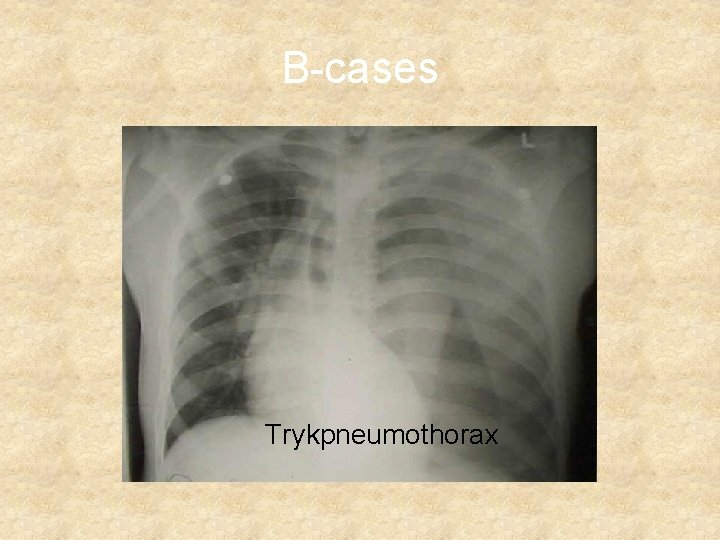 B-cases Pneumothorax Trykpneumothorax 