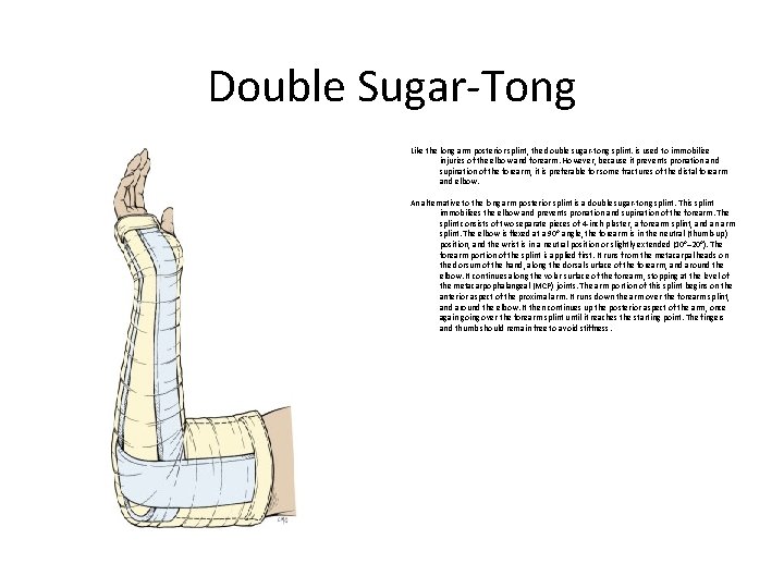 Double Sugar-Tong Like the long arm posterior splint, the double sugar-tong splint. is used