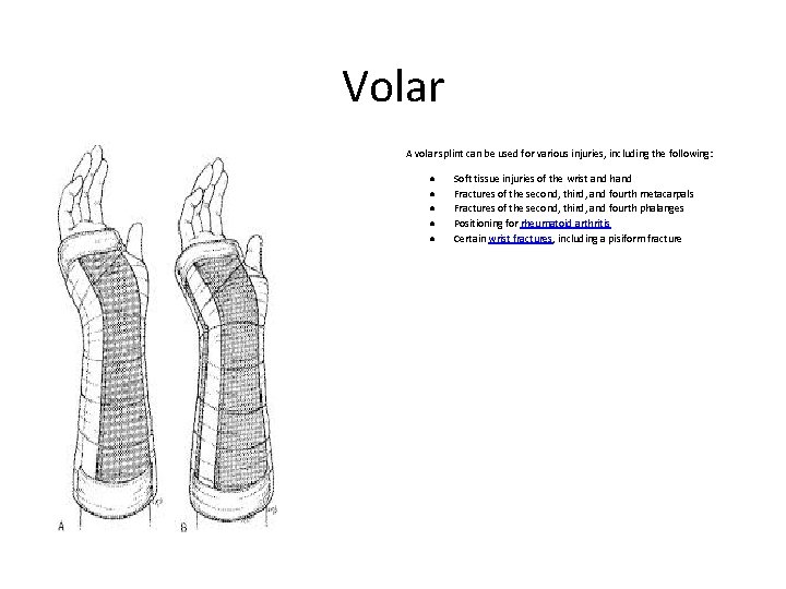 Volar A volar splint can be used for various injuries, including the following: ●