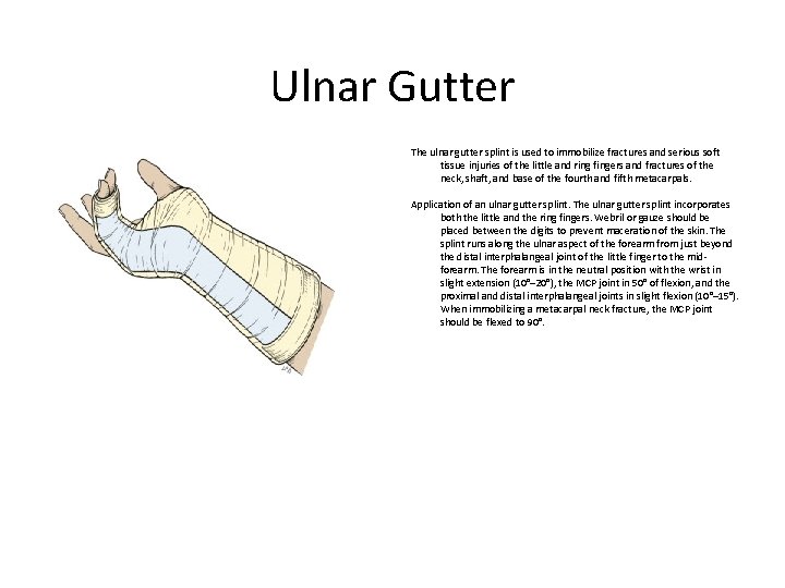 Ulnar Gutter The ulnar gutter splint is used to immobilize fractures and serious soft