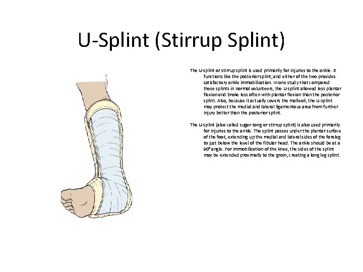 U-Splint (Stirrup Splint) The U-splint or stirrup splint is used primarily for injuries to