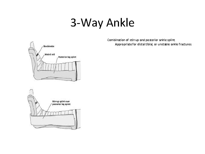 3 -Way Ankle Combination of stirrup and posterior ankle splint. Appropriate for distal tibial,