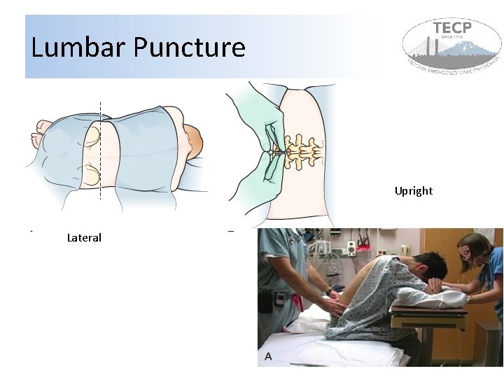 Lumbar Puncture Upright Lateral 