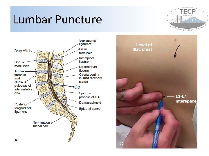 Lumbar Puncture Lumbar Puncture