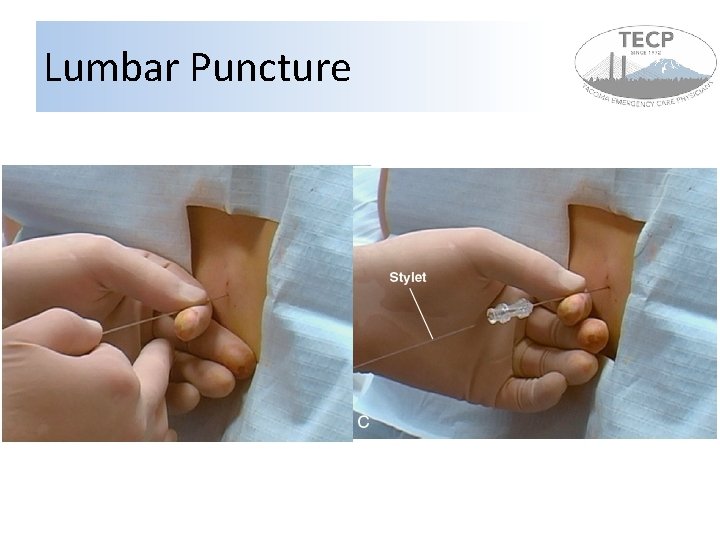 Lumbar Puncture 