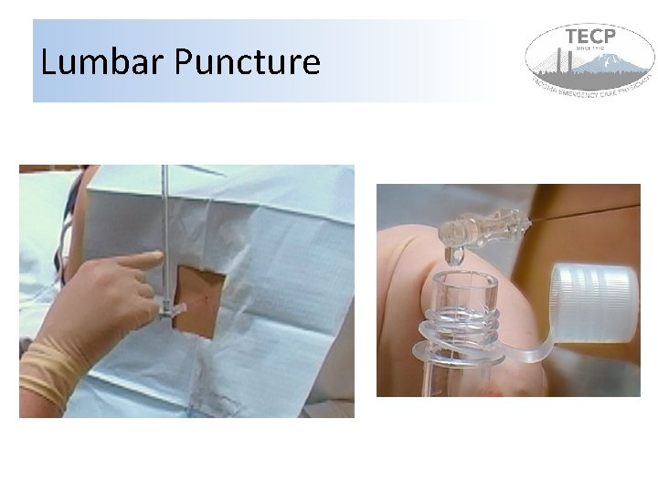 Lumbar Puncture 