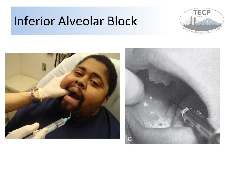 Inferior Alveolar Block 