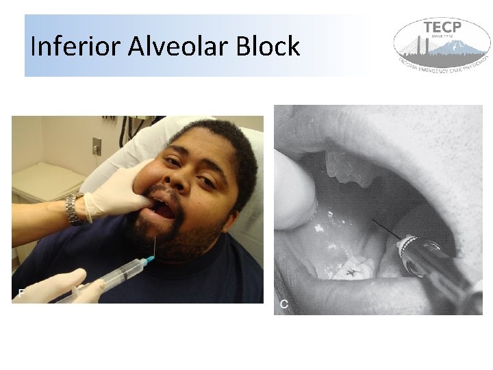 Inferior Alveolar Block Inferior Alveolar Block