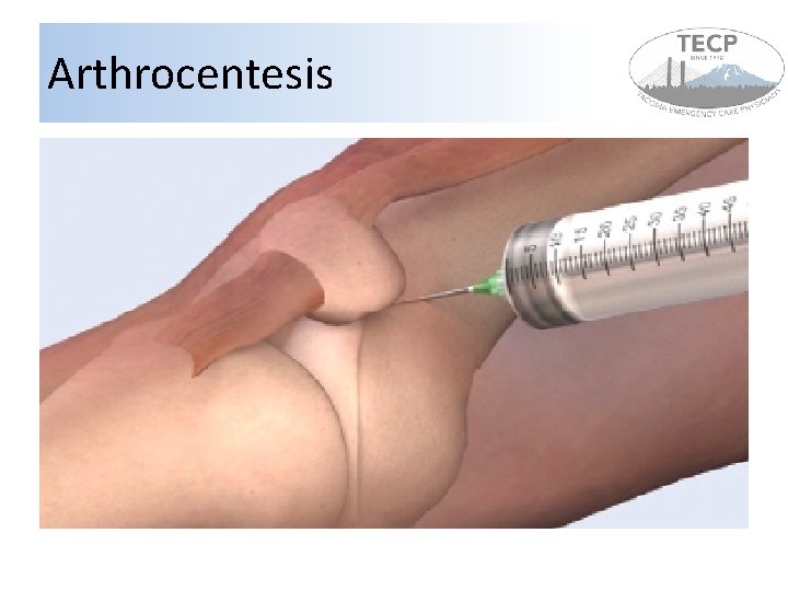 Arthrocentesis Arthrocentesis