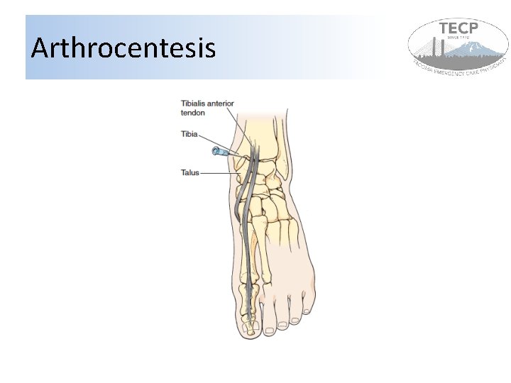 Arthrocentesis 