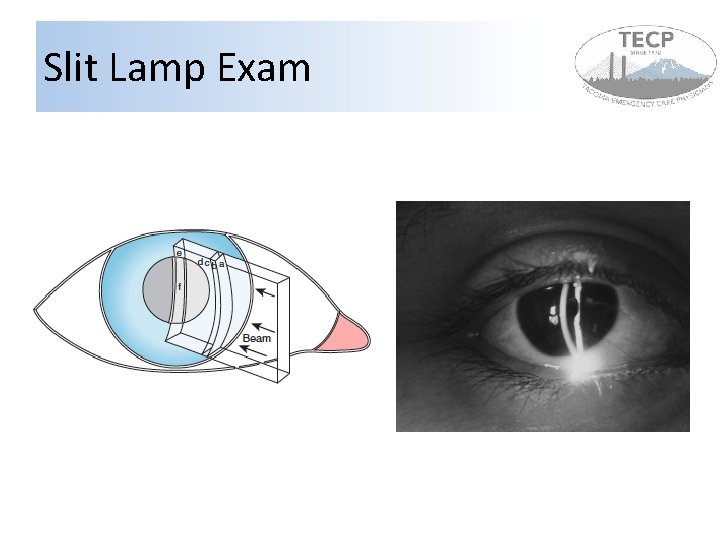 Slit Lamp Exam Slit Lamp Exam