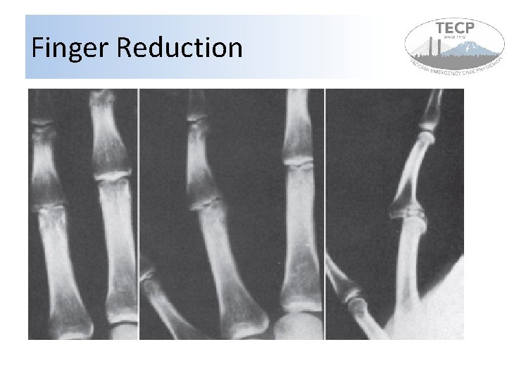 Finger Reduction 