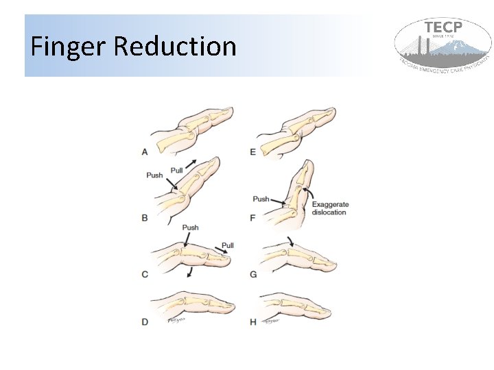 Finger Reduction Finger Reduction