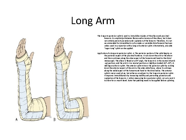 Long Arm The long arm posterior splint is used to immobilize injuries of the