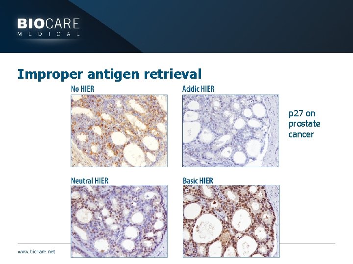 Improper antigen retrieval p 27 on prostate cancer 