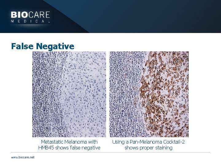 False Negative Metastatic Melanoma with HMB 45 shows false negative Using a Pan-Melanoma Cocktail-2