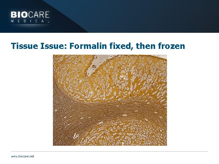 Tissue Issue: Formalin fixed, then frozen 