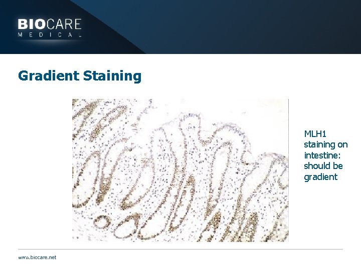 Gradient Staining MLH 1 staining on intestine: should be gradient 