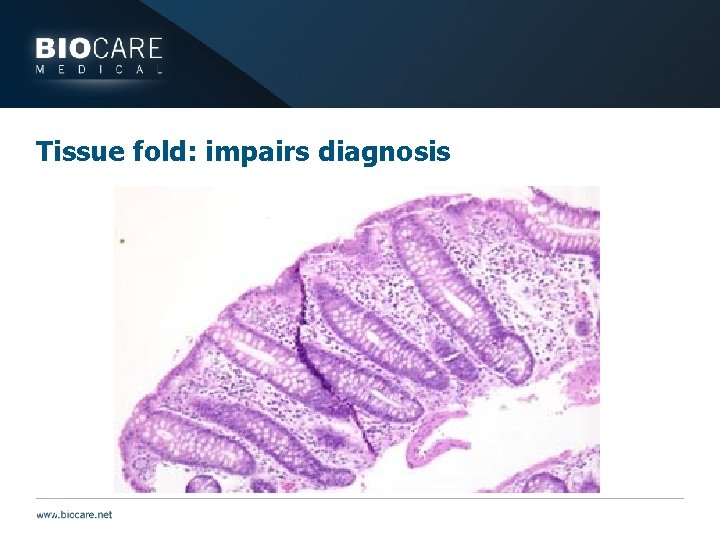 Tissue fold: impairs diagnosis 