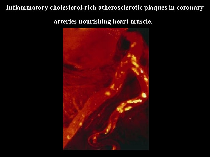 Inflammatory cholesterol-rich atherosclerotic plaques in coronary arteries nourishing heart muscle. 