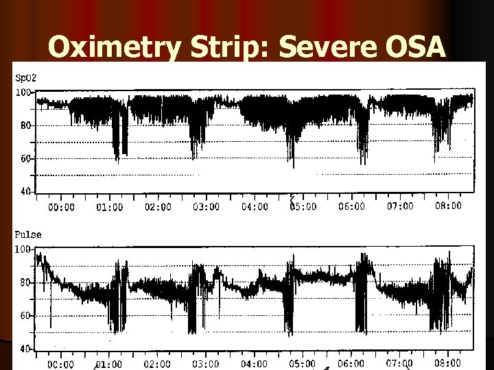 Oximetry Strip: Severe OSA 