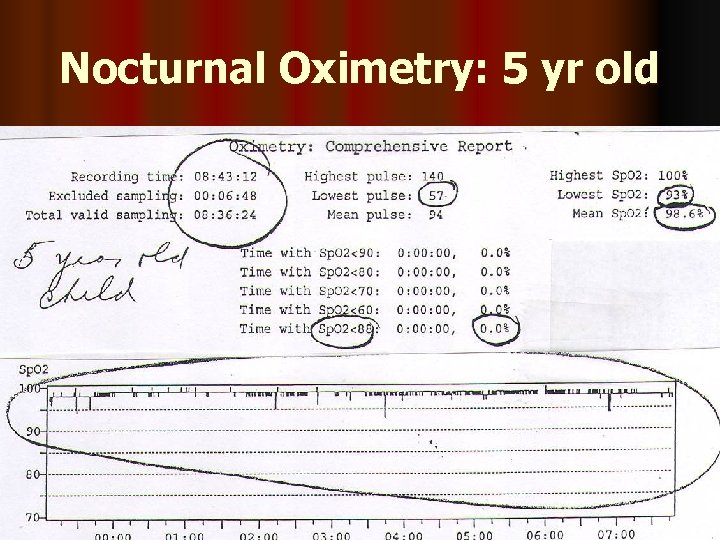 Nocturnal Oximetry: 5 yr old 