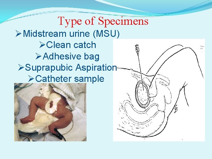 Type of Specimens ØMidstream urine (MSU) ØClean catch ØAdhesive bag ØSuprapubic Aspiration ØCatheter sample