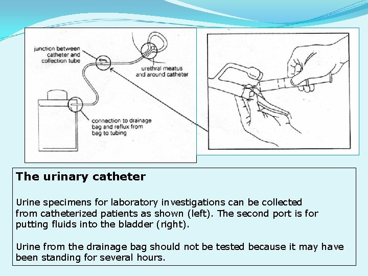 The urinary catheter Urine specimens for laboratory investigations can be collected from catheterized patients