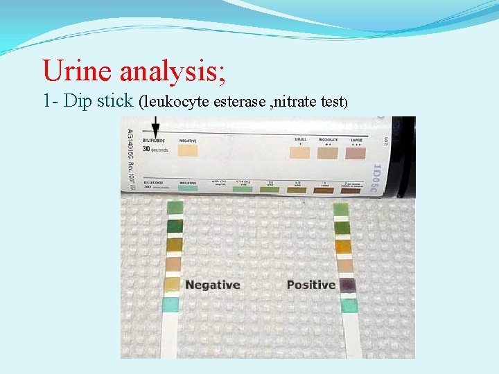 Urine analysis; 1 - Dip stick (leukocyte esterase , nitrate test) 