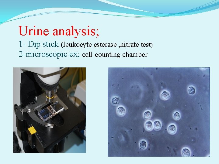 Urine analysis; 1 - Dip stick (leukocyte esterase , nitrate test) 2 -microscopic ex;
