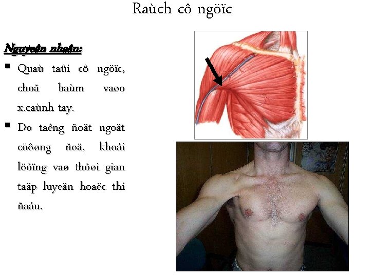 Raùch cô ngöïc Nguyeân nhaân: Quaù taûi cô ngöïc, choã baùm vaøo x. caùnh