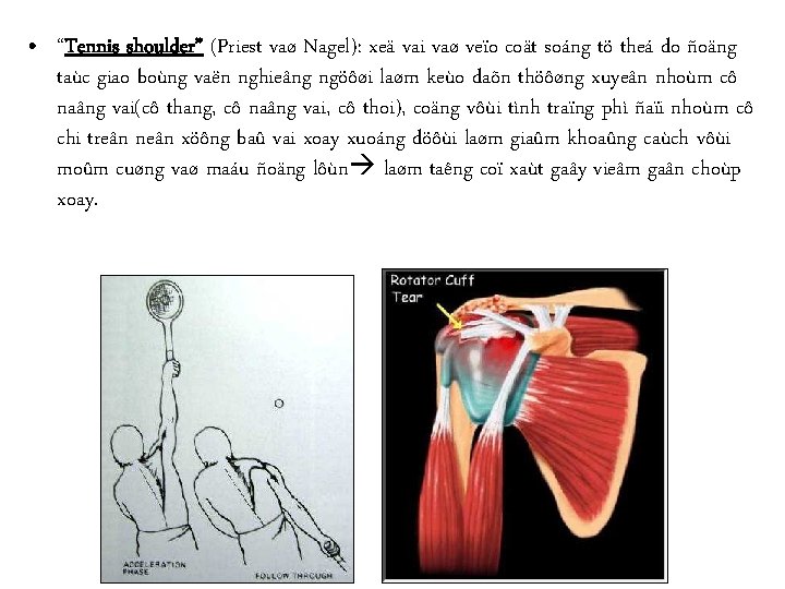  • “Tennis shoulder” (Priest vaø Nagel): xeä vai vaø veïo coät soáng tö