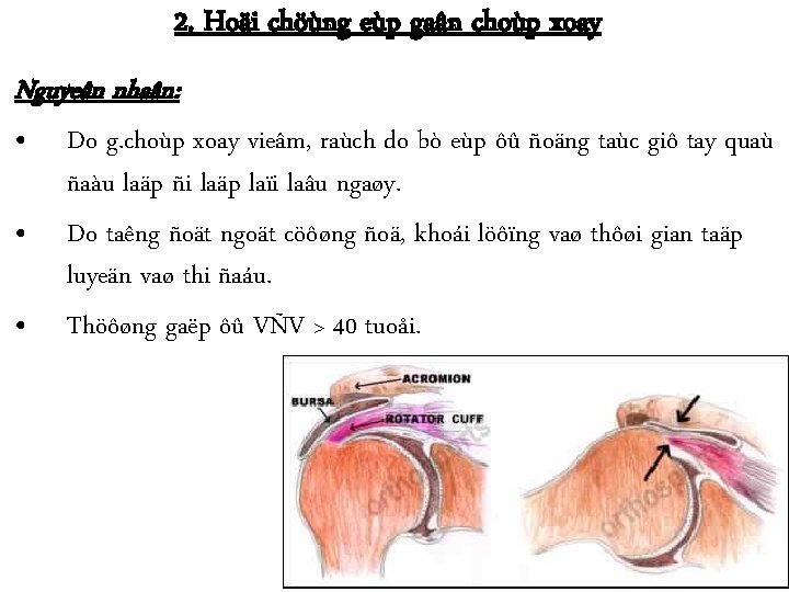 2. Hoäi chöùng eùp gaân choùp xoay Nguyeân nhaân: • Do g. choùp xoay