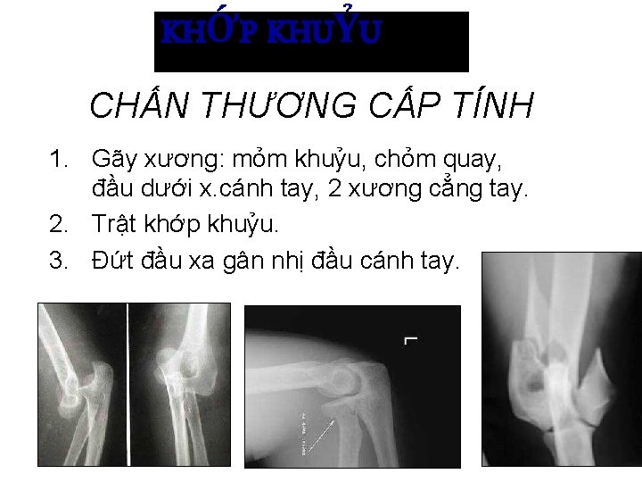 KHỚP KHUỶU CHẤN THƯƠNG CẤP TÍNH 1. Gãy xương: mỏm khuỷu, chỏm quay, đầu