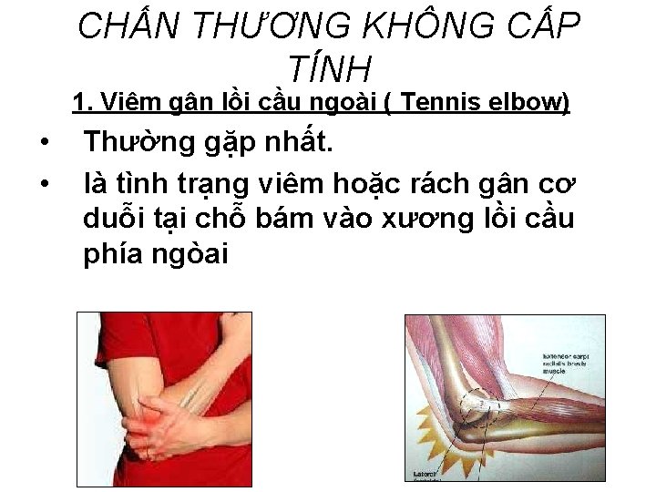 CHẤN THƯƠNG KHÔNG CẤP TÍNH 1. Viêm gân lồi cầu ngoài ( Tennis elbow)