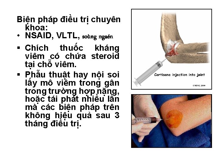 Biện pháp điều trị chuyên khoa: • NSAID, VLTL, soùng ngaén Chích thuốc kháng