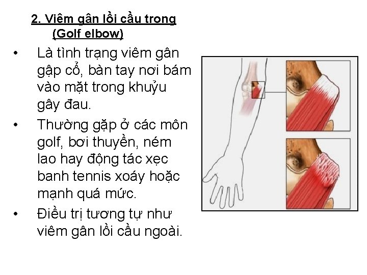 2. Viêm gân lồi cầu trong (Golf elbow) • • • Là tình trạng