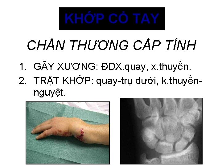 KHỚP CỔ TAY CHẤN THƯƠNG CẤP TÍNH 1. GÃY XƯƠNG: ĐDX. quay, x. thuyền.