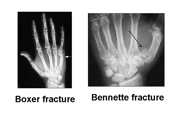 Boxer fracture Bennette fracture 