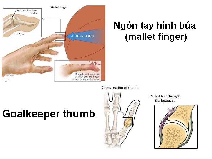 Ngón tay hình búa (mallet finger) Goalkeeper thumb 