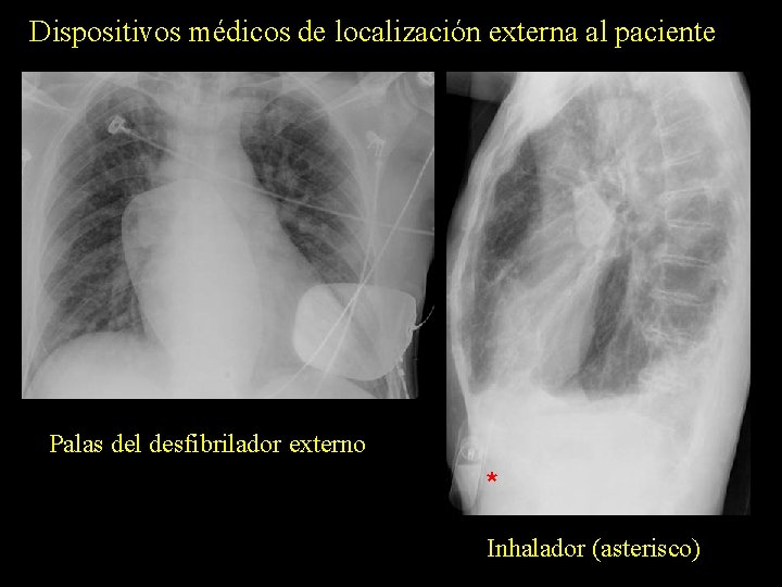 Dispositivos médicos de localización externa al paciente Palas del desfibrilador externo * Inhalador (asterisco)