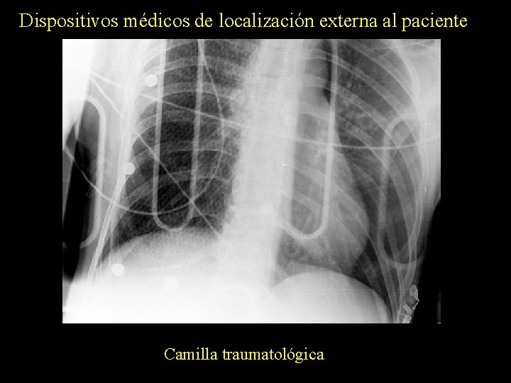 Dispositivos médicos de localización externa al paciente Camilla traumatológica 